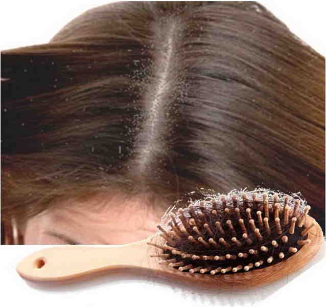Dandruff Causes Hair Loss
