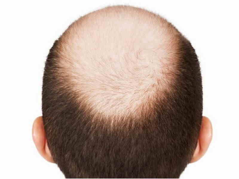 Causes Of Baldness
