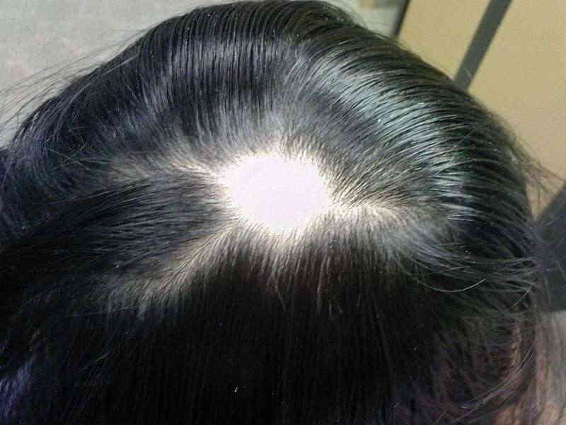 Alopecia the types and causes