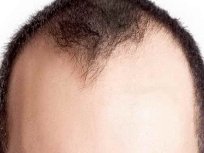 Prevent Baldness At Young Age